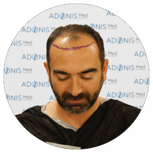 How to Design a Natural Hairline? Secrets of”Natural Appearance” in Hair Transplantation