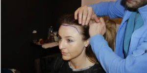 High hairline hair transplant