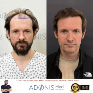 Confidence Transformation After Hair Transplant: A Story of Psychological Renewal