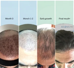 Hair Transplantation Recovery Process (Month by Month): Shock Loss and the Emergence of New Hair