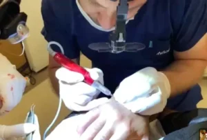 BHT- Body Hair Transplant