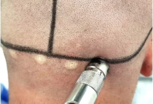 Painless Hair Transplant: A Method That Should Be Reevaluated