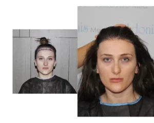 Before and after results after hair transplantation in women