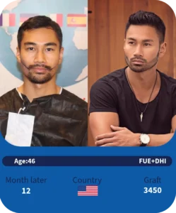 Combined Hair and Beard Transplant: A Guide to Maximum Transformation in One Session